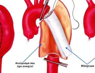 Ανεύρυσμα: Αυτά είναι τα συμπτώματα που πρέπει να προσέχετε